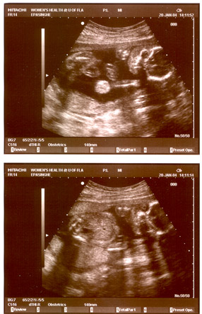 Here you can see the baby's head, and some arms and legs (sort of)!