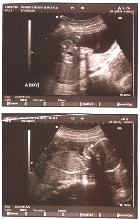 Top picture has pointer revealing gender, bottom shows baby from side.